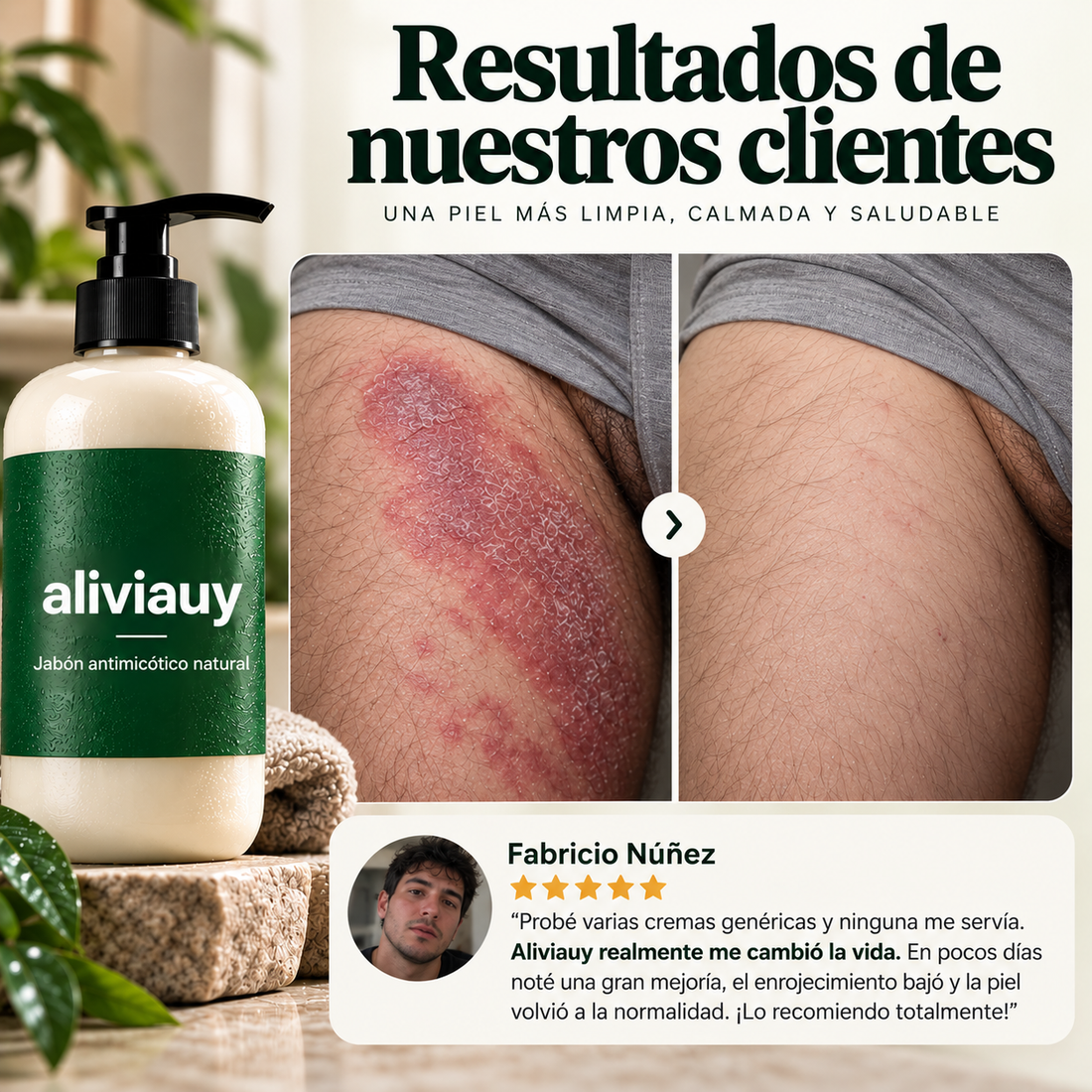 Jabón Antifúngico aliviauy™ Anti Tiña Inguinal – Fórmula natural para hongos en la piel